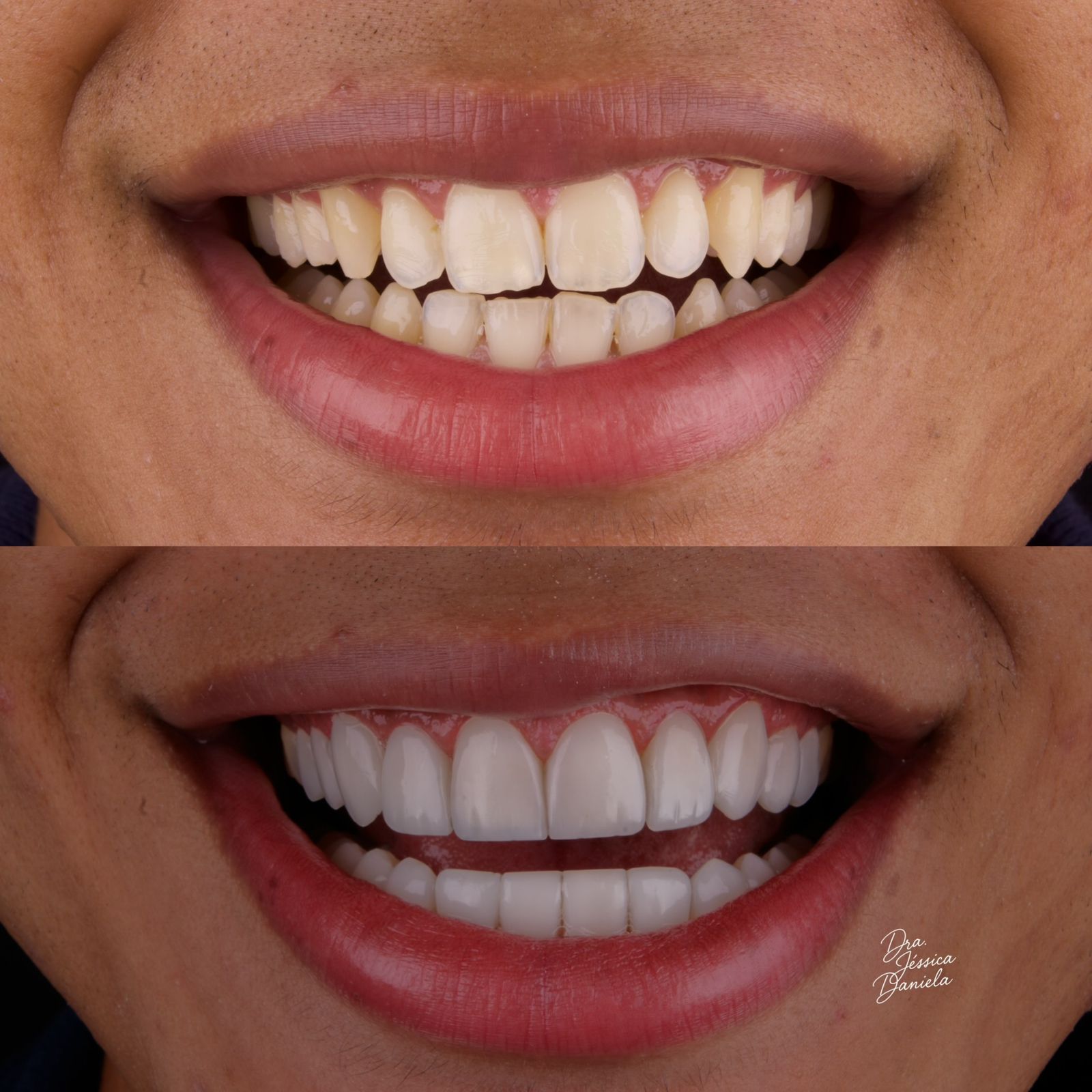 Detalhe de sorriso com facetas dentais