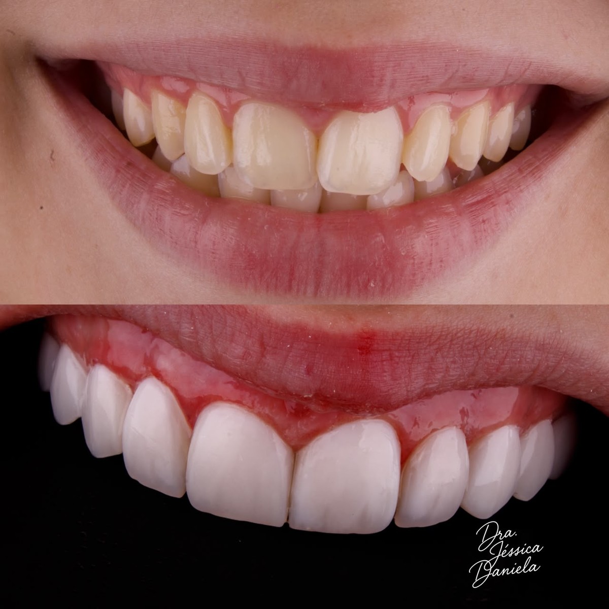 Caso de facetas em resina, antes e depois