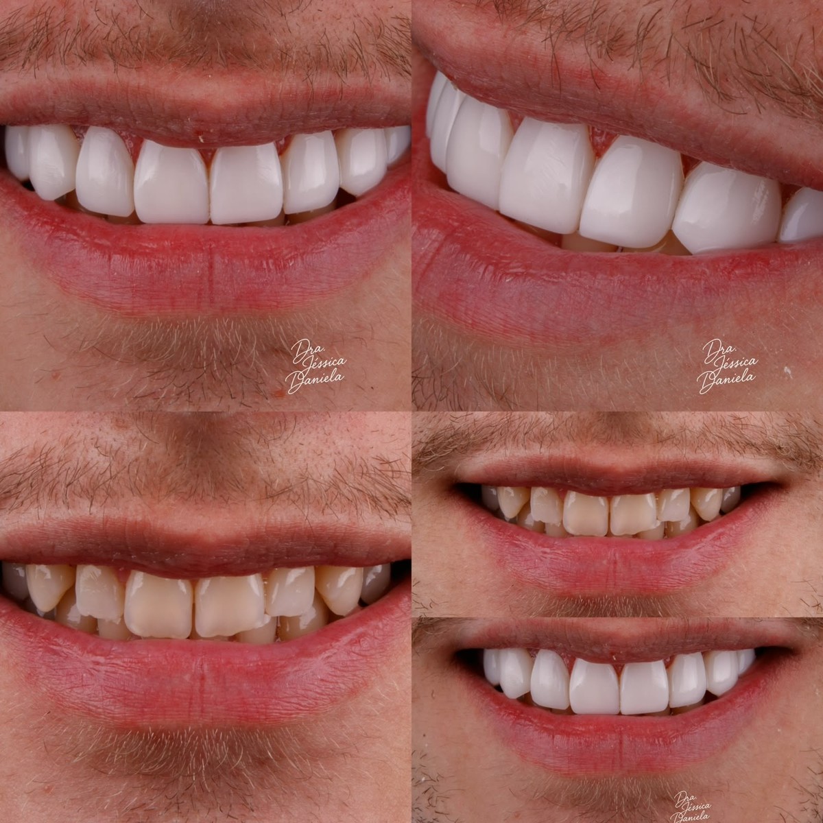 Comparativo de casos de facetas em resina