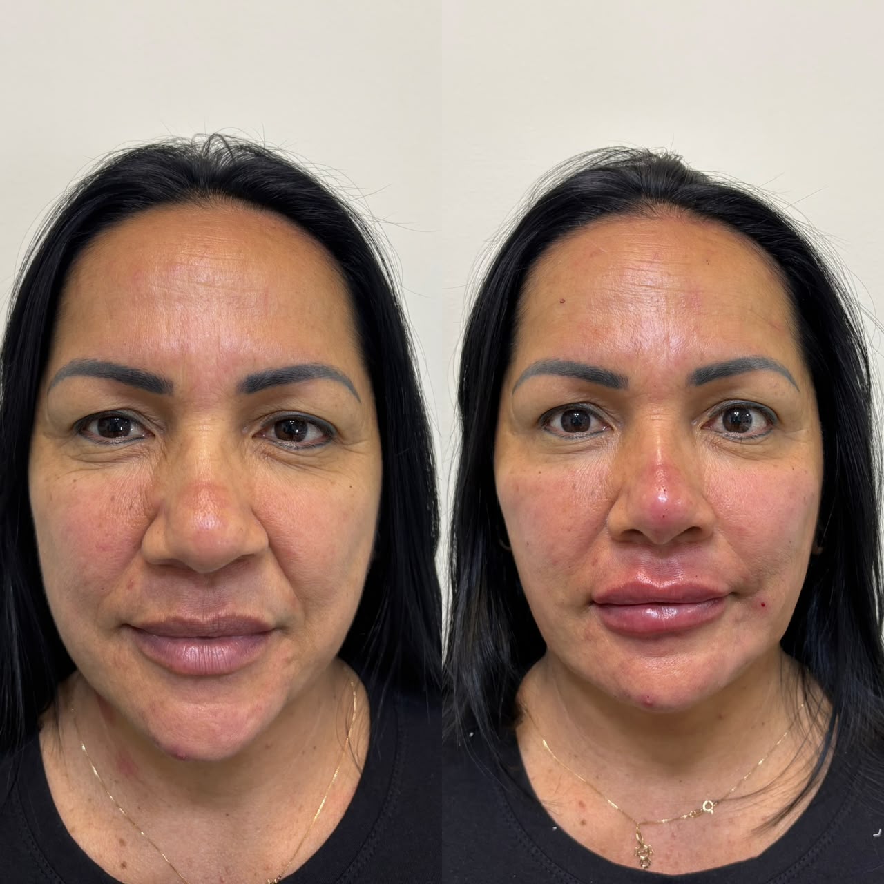 Antes e depois frontal de harmonização orofacial com preenchimento facial