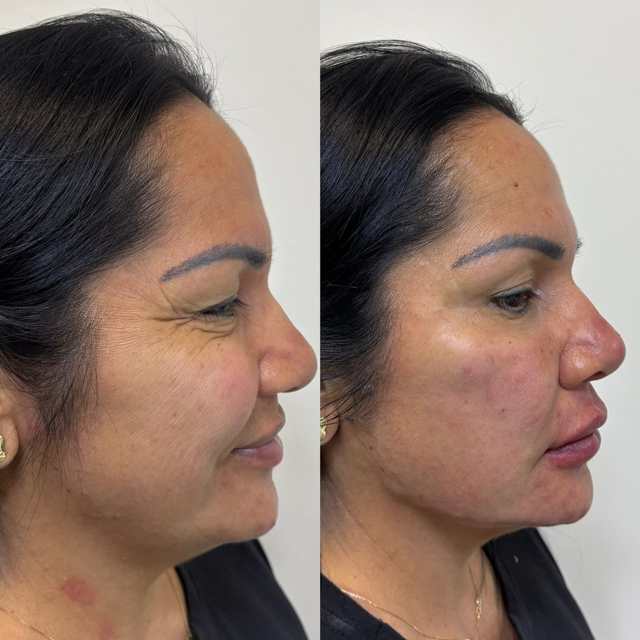 Antes e depois de perfil em harmonização orofacial