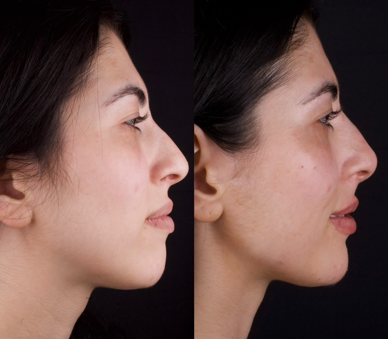 Antes e depois de perfil em harmonização orofacial com valorização do contorno facial